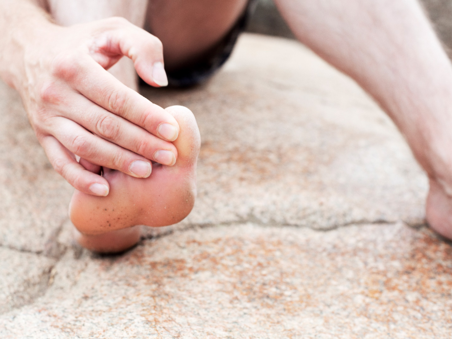 Hammer Toe: Comprehensive Guide - OrthoInfo - AAOS