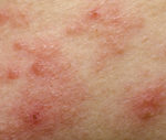 Dermatitis - Dr. Weil's Condition Care Guide